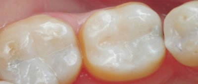 White Fillings