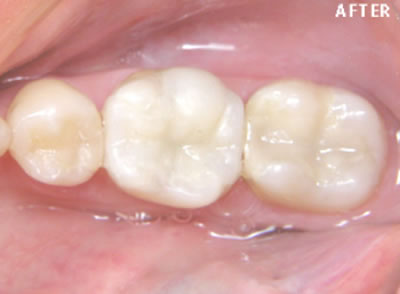 White Fillings