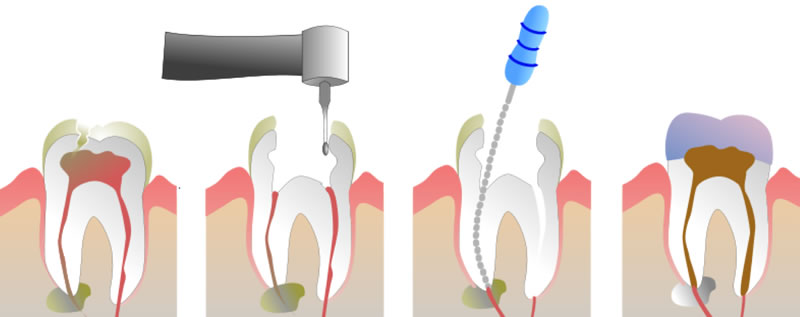 Root Canal